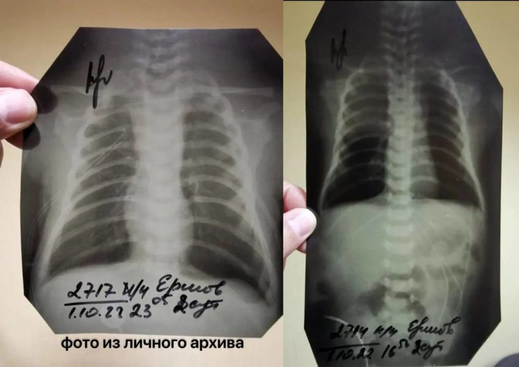 Рентген-снимок младенца Ершовых